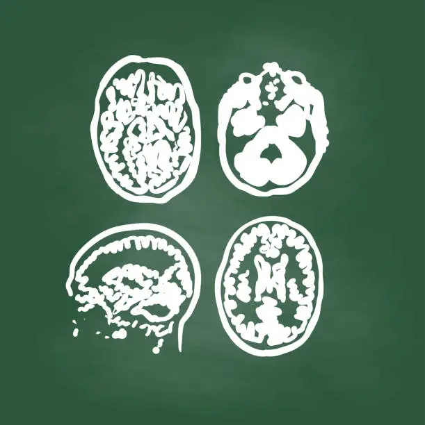 Vector illustration of Brain Scan Image Chalkboard