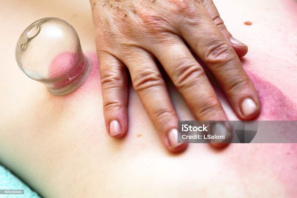 fire cupping treatment to cup sb therapy woman to cup sb, therapist removing a fire cupping glass from the back of a young woman fire cupping treatment Adult Stock Photo