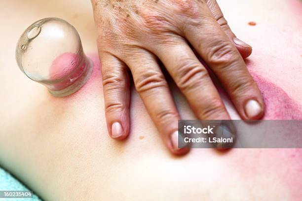 Fire Cupping Treatment To Cup Sb Therapy Woman Stock Photo - Download Image Now - Adult, Alternative Therapy, Asian Culture