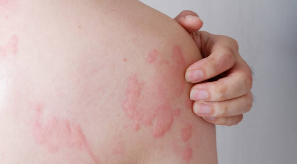 istock Close up image of skin texture suffering severe Allergy. 1602388938
