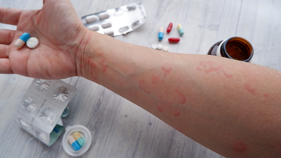 Close up image of arm suffering severe urticaria or hives or kaligata with ilustration of allergy trigger. Pills, capsules  and tablets