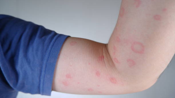 istock Close up image of skin texture suffering severe Allergy. 1602407485