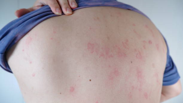 istock Close up image of skin texture suffering severe Allergy. 1602408518