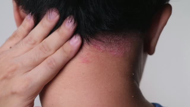 a man scratching his Psoriasis on his nape.