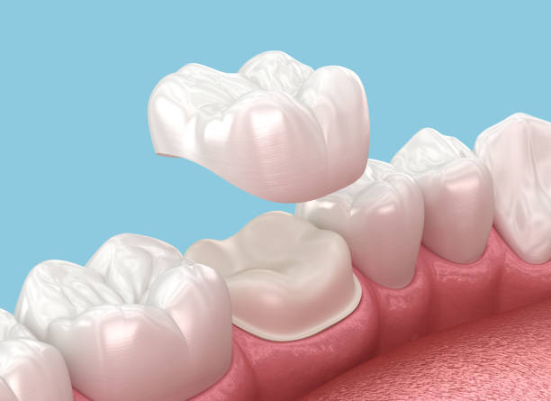 colocación de la corona dental sobre el diente molar. ilustración 3d - corona-dental fotografías e imágenes de stock