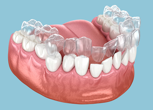 Invisalign braces or invisible retainer. Medically accurate dental 3D illustration