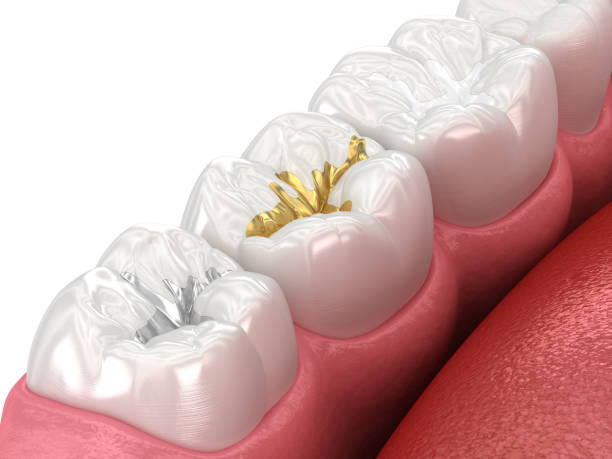 istock Dental fillings: ceramic, golden, metal. Dental 3D illustration 1602825186