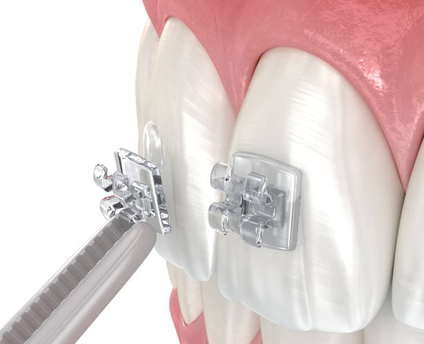 istock Creal braces placement over tooth. Dental 3D illustration 1602825209