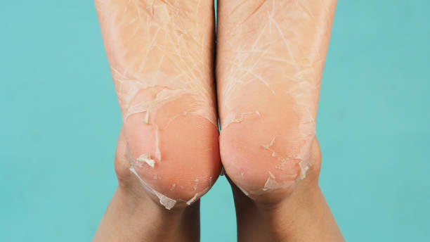 füße schälen sich oder entfernen abgestorbene haut auf mintgrünem hintergrund. - smooth human skin human leg human foot stock-fotos und bilder