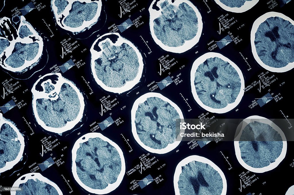 Ct scan of human scull Computed tomography of human head.Separated by zones. Brain Damage Stock Photo