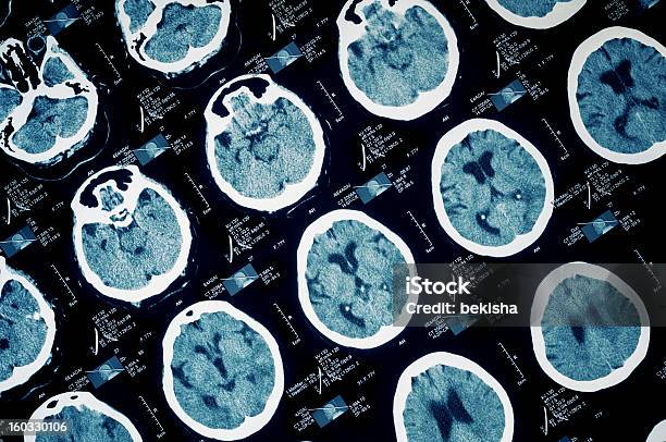 Ct Scan Of Human Scull Stock Photo - Download Image Now - Brain Damage, Alzheimer's Disease, MRI Scan