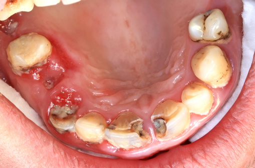 Unhealthy teeth, caries and inflammation in mouth