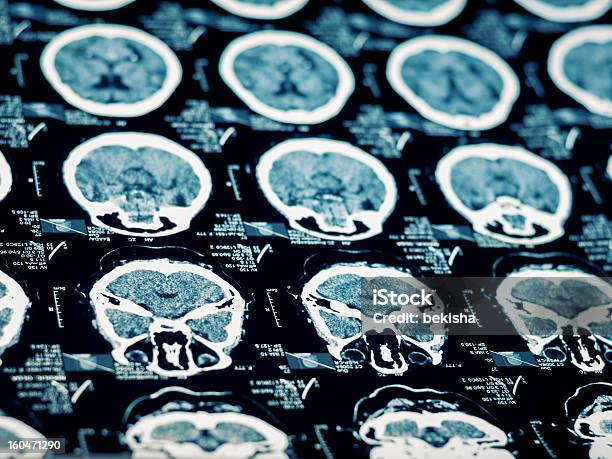 Mr Scan Of Human Head Stock Photo - Download Image Now - Brain Damage, Radiation, Medical Scan