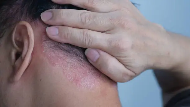 Photo of Psoriasis on the nape of a man. skin with psoriasis.