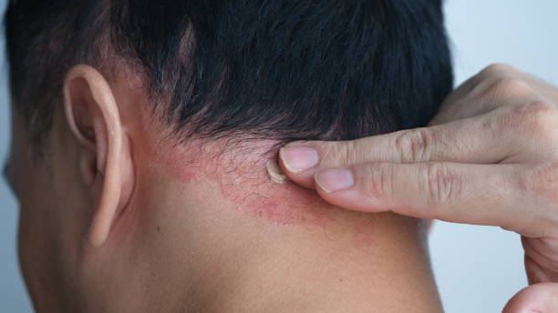 istock A man is applying ointment to Psoriasis on the head. 1604749173