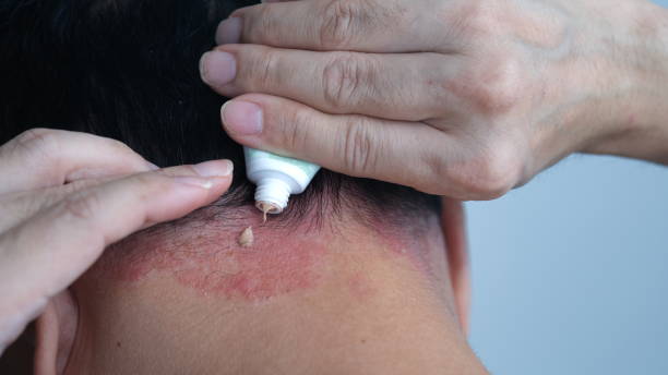 istock A man is applying ointment to Psoriasis on the head. 1604750228