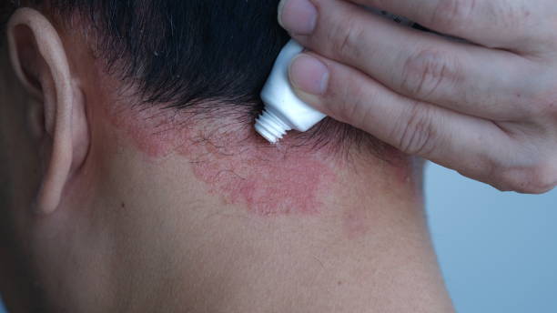istock A man is applying ointment to Psoriasis on the head. 1604750242