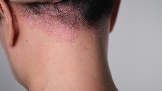 Psoriasis on the nape of a man. skin with psoriasis.