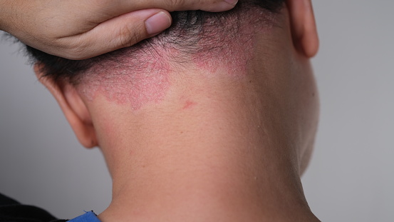 Psoriasis on the nape of a man. skin with psoriasis.