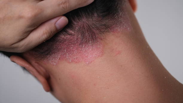 Psoriasis on the nape of a man. skin with psoriasis. Psoriasis on the nape of a man. skin with psoriasis. psoriasis stock pictures, royalty-free photos & images