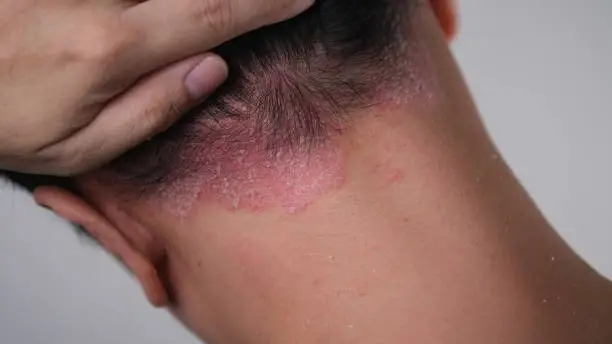 Photo of Psoriasis on the nape of a man. skin with psoriasis.