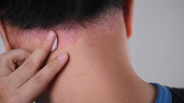 istock A man is applying ointment to Psoriasis on the head. 1604751337