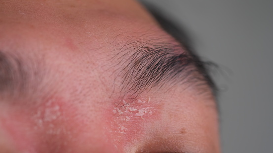 a man with psoriasis near the eyebrows