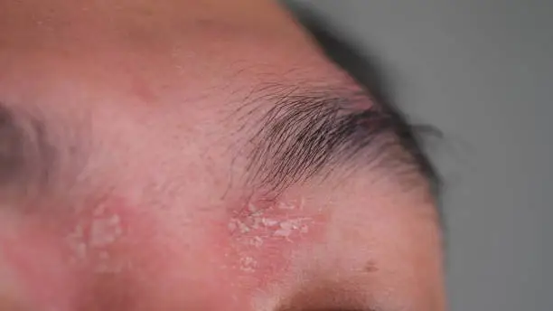 Photo of a man with psoriasis near the eyebrows