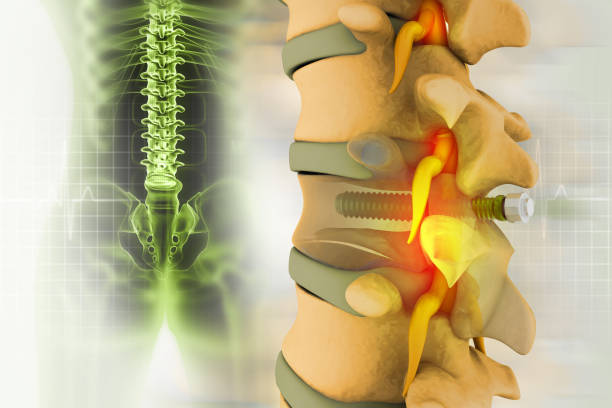 istock spinal column with implant, screw placement, 3d illustration 1604867399