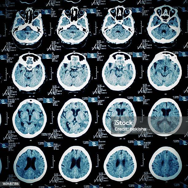 Mr Scan Pattern Of Human Head Stock Photo - Download Image Now - Brain Damage, Cerebral Hemisphere, Data