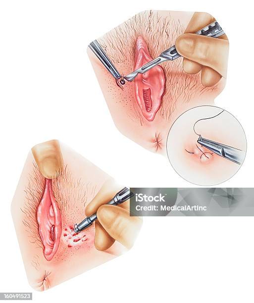 Vulva バイオプシー - 外陰部のベクターアート素材や画像を多数ご用意 - 外陰部, 膣, 手術