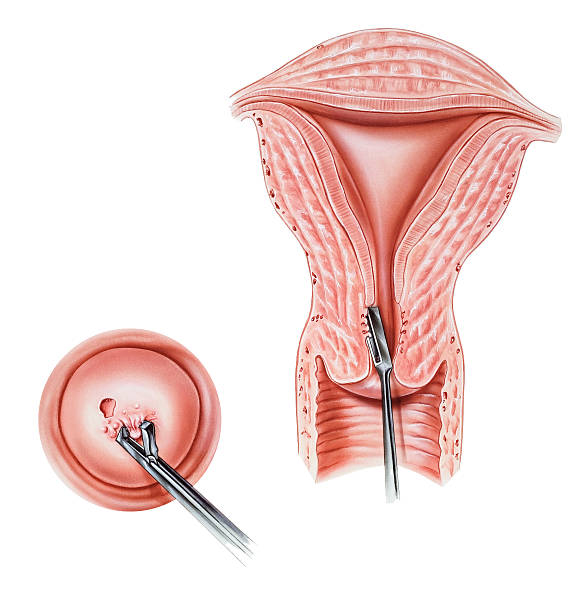 Cervix &amp; Endocervix - Biopsy Biopsy of the cervix and endocervix. Shown are an external biopsy (left) and an internal biopsy (right). These colposcopy- directed procedures confirm a diagnosis suggested by an abnormal Pap smear and may also be therapeutic with small lesions. pap smear stock illustrations