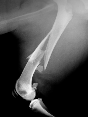 bone fracture. Lateral radiograph.