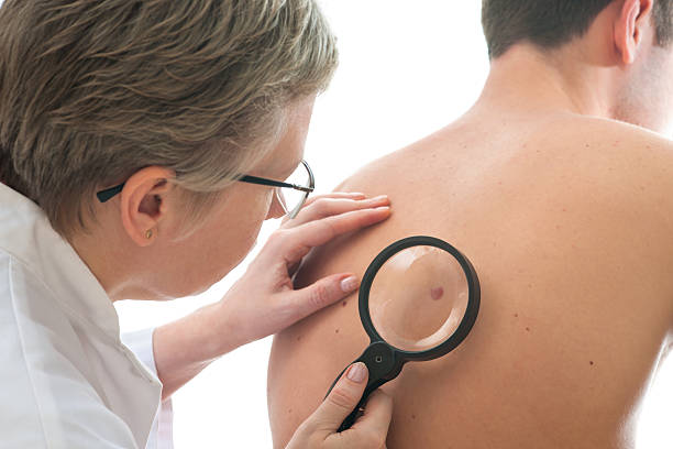 Dermatologist examines a mole Dermatologist examines a mole of male patient skin cancer stock pictures, royalty-free photos & images