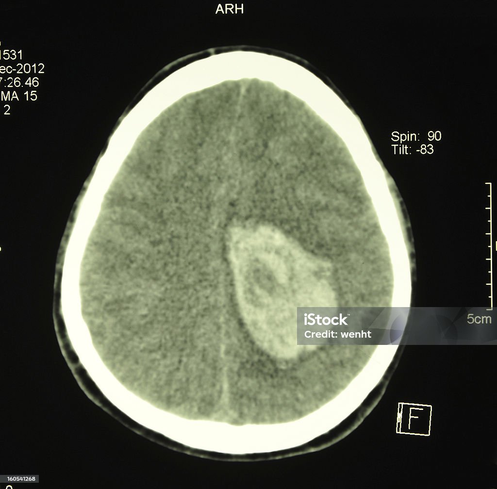 Kopf CT-scan mit intracerebral hematoma - Lizenzfrei Computertomogramm Stock-Foto