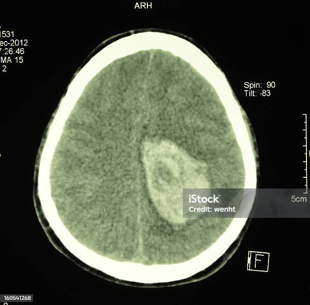 Kopf Ctscan Mit Intracerebral Hematoma Stockfoto und mehr Bilder von Computertomogramm - Computertomogramm, Blut, Hirn