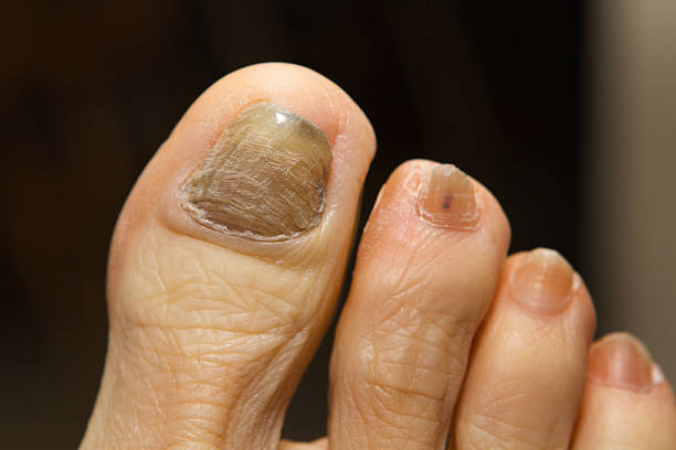 quimioterapia hongo uña del dedo del pie - discolored fotografías e imágenes de stock