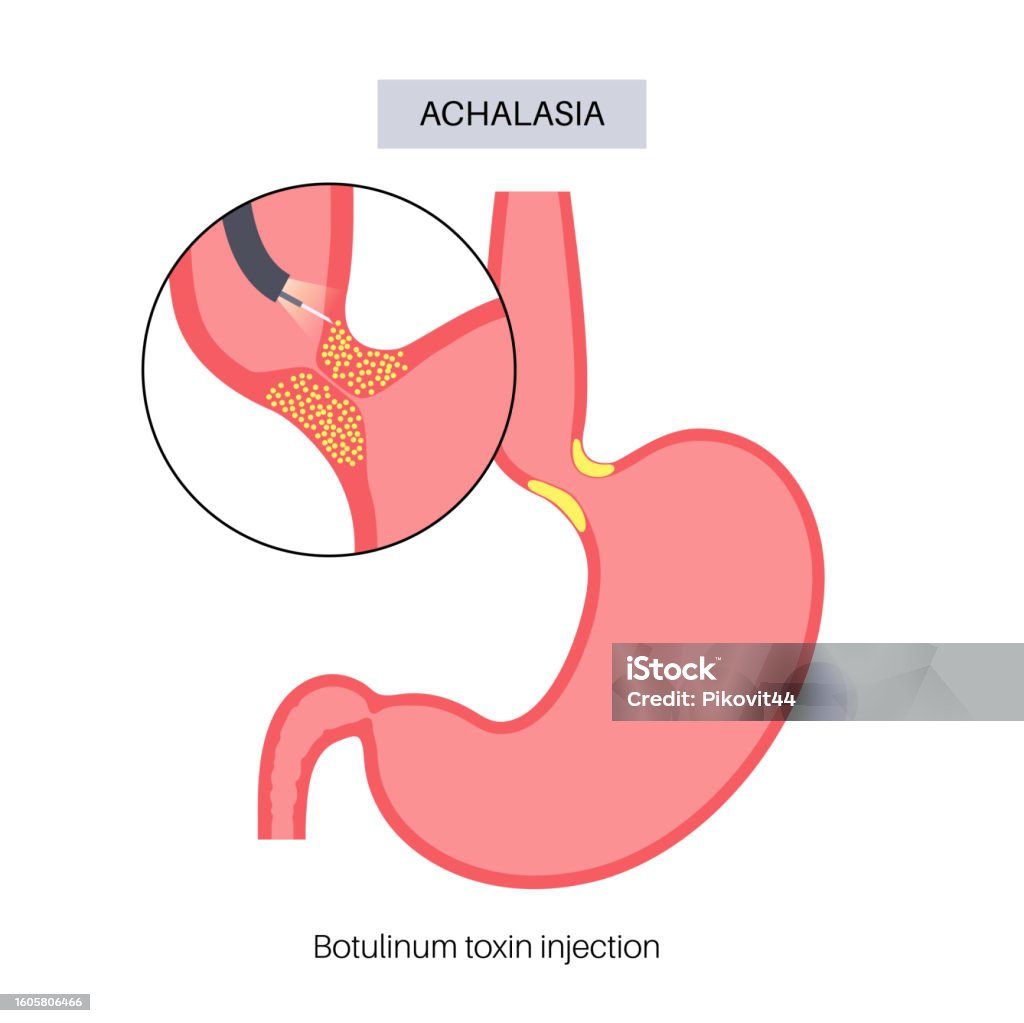 Doxin Injection Esophageal Botulinum Toxin Injection Stock Illustration - Download ...