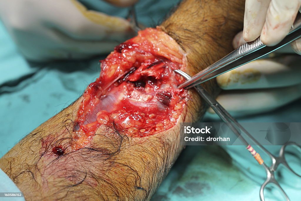 Mano intervento chirurgico - Foto stock royalty-free di Anatomia umana
