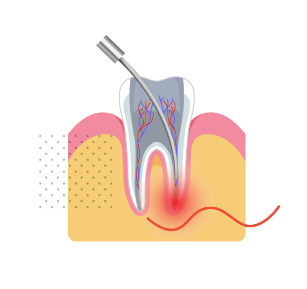 zabieg stomatologiczny - leczenie kanałowe - ilustracja stockowa - human teeth gums dental hygiene inflammation stock illustrations