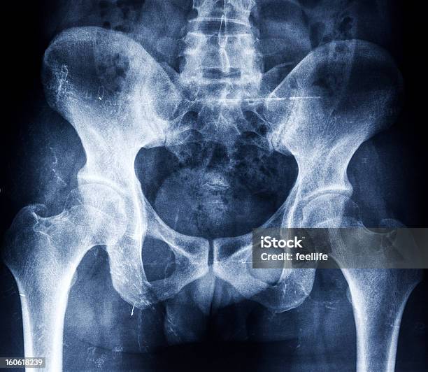 Pelvis Humanos De Rayos X Foto de stock y más banco de imágenes de Pelvis - Pelvis, Imagen de rayos X, Zona Genital