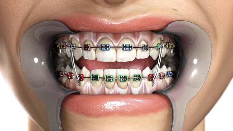 Computer generated teeth crowding time-lapse.