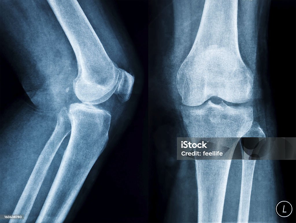 Espectáculo de ruptura de menisco radiografía de la rodilla - Foto de stock de Articulación libre de derechos