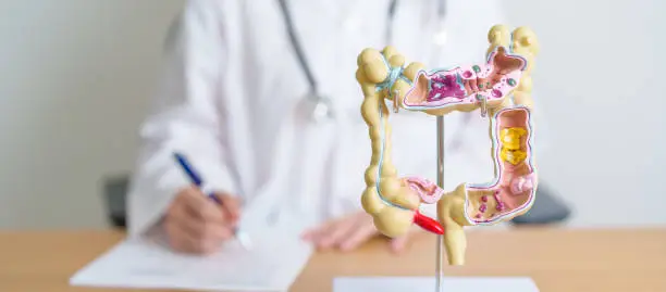 Photo of Doctor with human Colon anatomy model. Colonic disease, Large Intestine, Colorectal cancer, Ulcerative colitis, Diverticulitis, Irritable bowel syndrome, Digestive system and Health concept