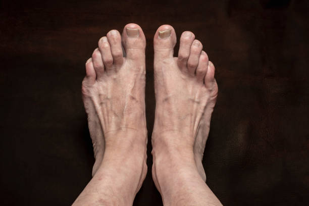 istock nail fungus infection 1607547956