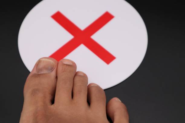 istock Feet with black nails due to injury 1607551059