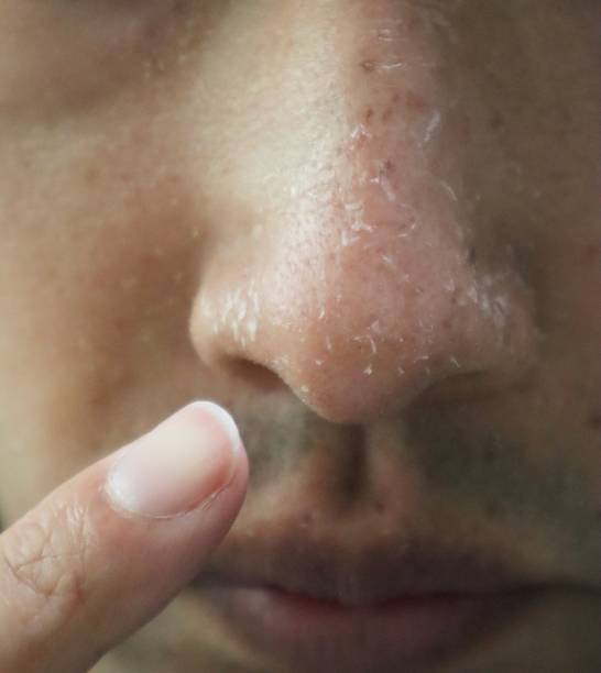 istock A person pointing to a rough nose 1607571072