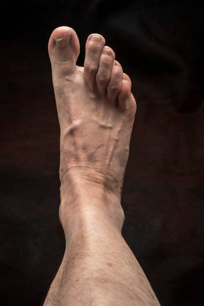 nail fungus infection