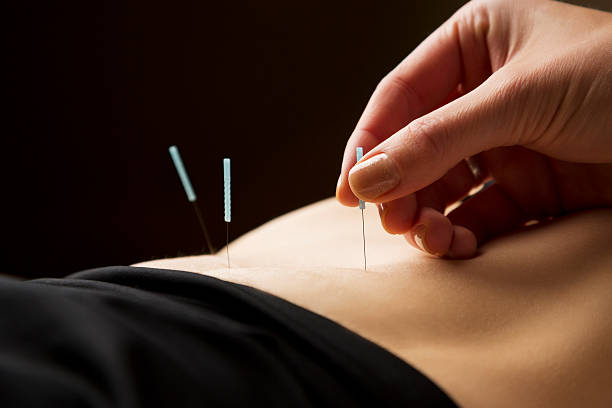 femme s'acupuncture soin au spa - acupuncture needle photos et images de collection