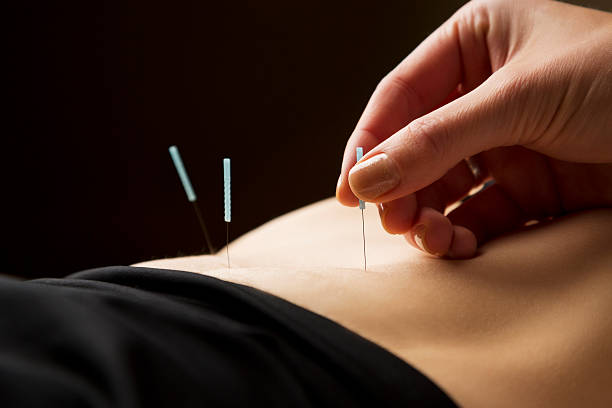 Kobieta coraz Akupunktura zabiegi w spa – zdjęcie
